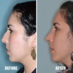 Rhinoplasty Before and After Photos in Miami, FL, Patient 298