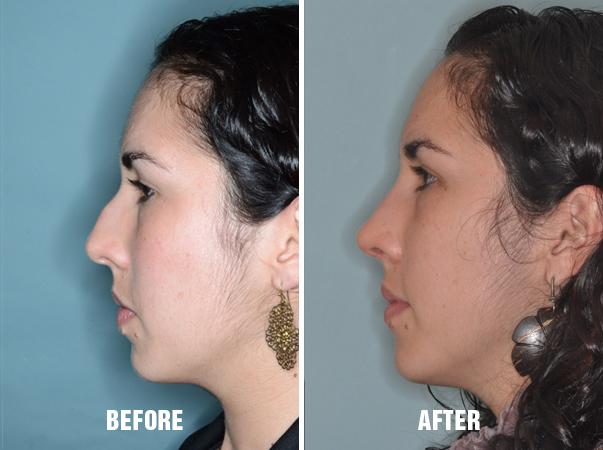 Rhinoplasty Before and After Photos in Miami, FL, Patient 298