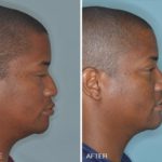 Rhinoplasty Before and After Photos in Miami, FL, Patient 302