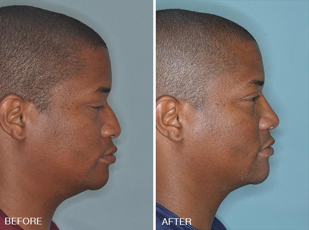 Rhinoplasty Before and After Photos in Miami, FL, Patient 302