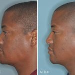 Rhinoplasty Before and After Photos in Miami, FL, Patient 302