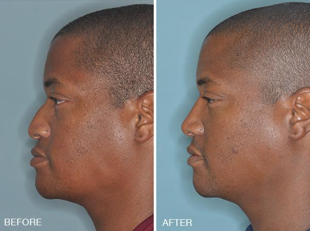 Rhinoplasty Before and After Photos in Miami, FL, Patient 302