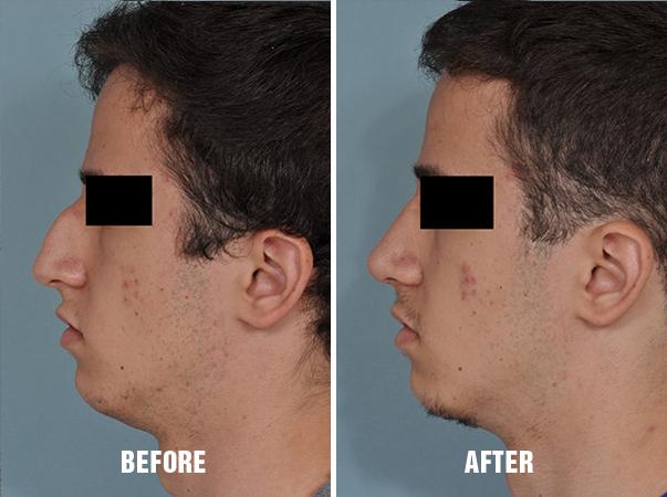 Rhinoplasty Before and After Photos in Miami, FL, Patient 184