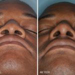 Rhinoplasty Before and After Photos in Miami, FL, Patient 302