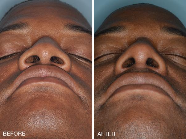 Rhinoplasty Before and After Photos in Miami, FL, Patient 302