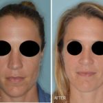 Rhinoplasty Before and After Photos in Miami, FL, Patient 315