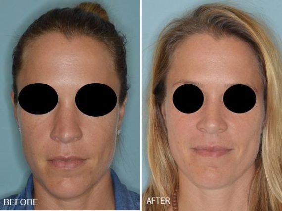 Rhinoplasty Before and After Photos in Miami, FL, Patient 315