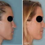 Rhinoplasty Before and After Photos in Miami, FL, Patient 315