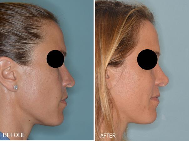 Rhinoplasty Before and After Photos in Miami, FL, Patient 315
