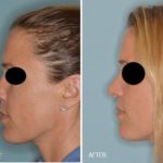 Rhinoplasty Before and After Photos in Miami, FL, Patient 315