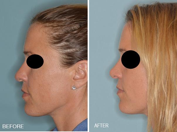 Rhinoplasty Before and After Photos in Miami, FL, Patient 315