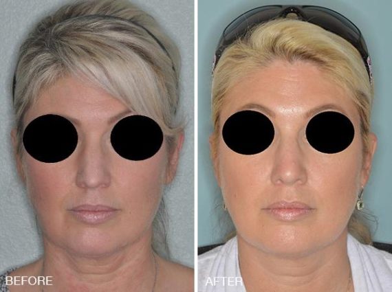 Rhinoplasty Before and After Photos in Miami, FL, Patient 328