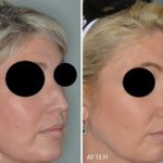 Rhinoplasty Before and After Photos in Miami, FL, Patient 328