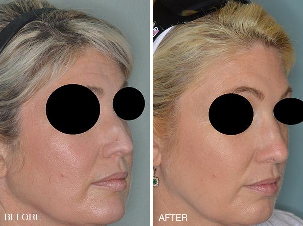 Rhinoplasty Before and After Photos in Miami, FL, Patient 328