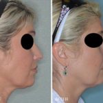 Rhinoplasty Before and After Photos in Miami, FL, Patient 328