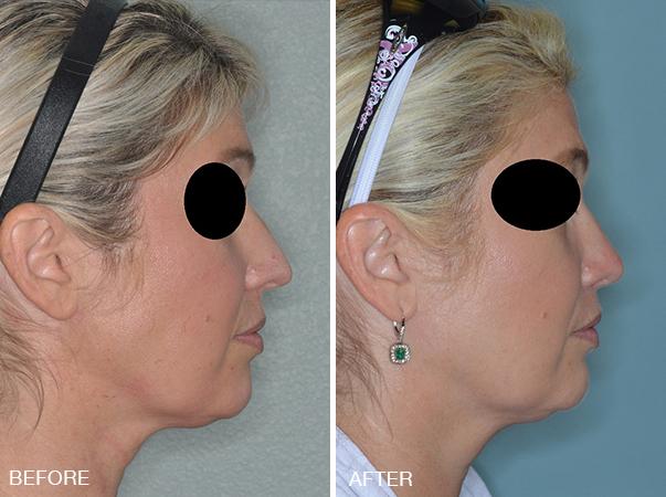 Rhinoplasty Before and After Photos in Miami, FL, Patient 328