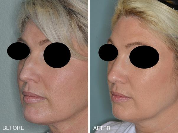 Rhinoplasty Before and After Photos in Miami, FL, Patient 328