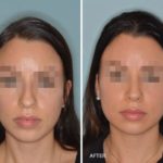 Rhinoplasty Before and After Photos in Miami, FL, Patient 341