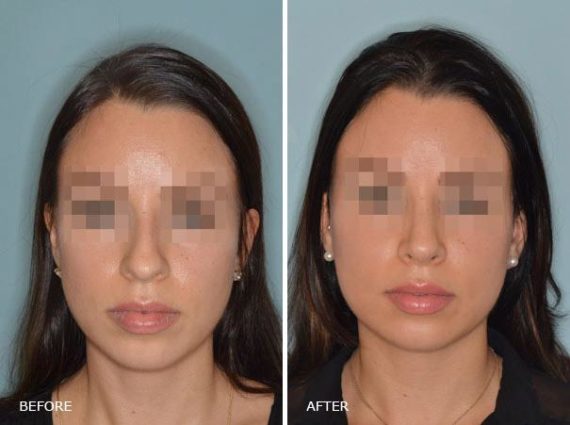 Rhinoplasty Before and After Photos in Miami, FL, Patient 341