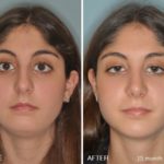 Rhinoplasty Before and After Photos in Miami, FL, Patient 191