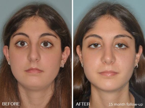 Rhinoplasty Before and After Photos in Miami, FL, Patient 191