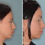 Rhinoplasty Before and After Photos in Miami, FL, Patient 341