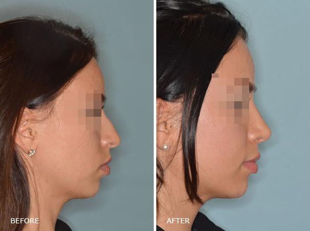 Rhinoplasty Before and After Photos in Miami, FL, Patient 341