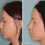 Rhinoplasty Before and After Photos in Miami, FL, Patient 341