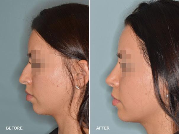 Rhinoplasty Before and After Photos in Miami, FL, Patient 341