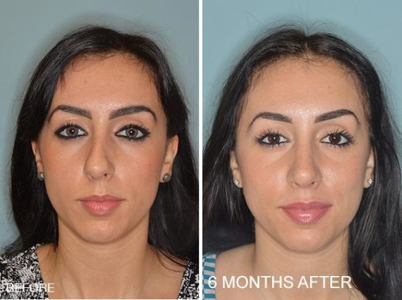 Rhinoplasty Before and After Photos in Miami, FL, Patient 351