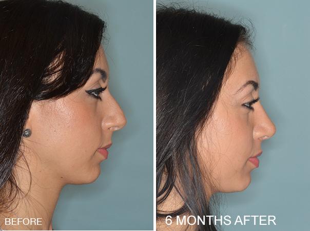 Rhinoplasty Before and After Photos in Miami, FL, Patient 351