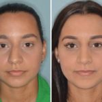 Rhinoplasty Before and After Photos in Miami, FL, Patient 369