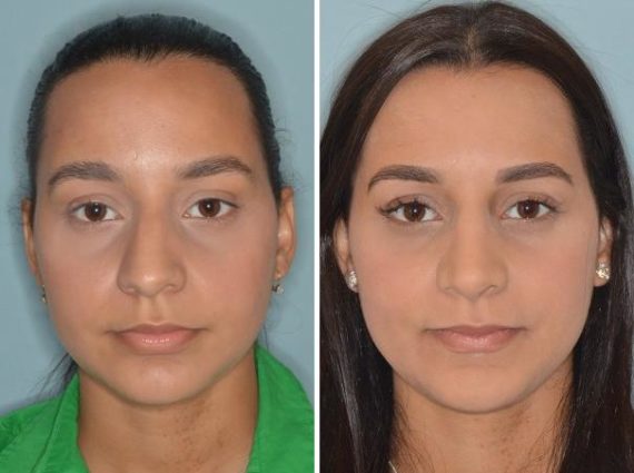 Rhinoplasty Before and After Photos in Miami, FL, Patient 369