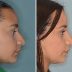 Rhinoplasty Before and After Photos in Miami, FL, Patient 369