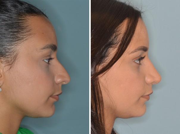 Rhinoplasty Before and After Photos in Miami, FL, Patient 369