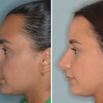 Rhinoplasty Before and After Photos in Miami, FL, Patient 369