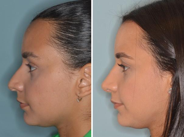 Rhinoplasty Before and After Photos in Miami, FL, Patient 369