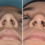 Rhinoplasty Before and After Photos in Miami, FL, Patient 369