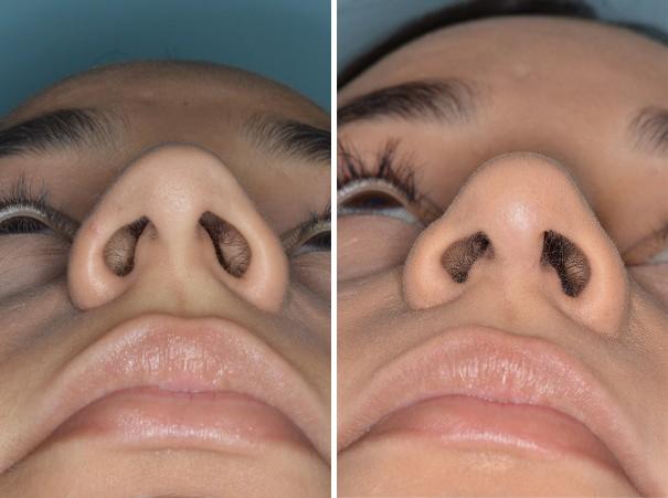 Rhinoplasty Before and After Photos in Miami, FL, Patient 369