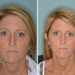 Rhinoplasty Before and After Photos in Miami, FL, Patient 380
