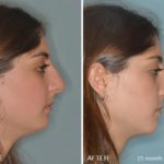 Rhinoplasty Before and After Photos in Miami, FL, Patient 191