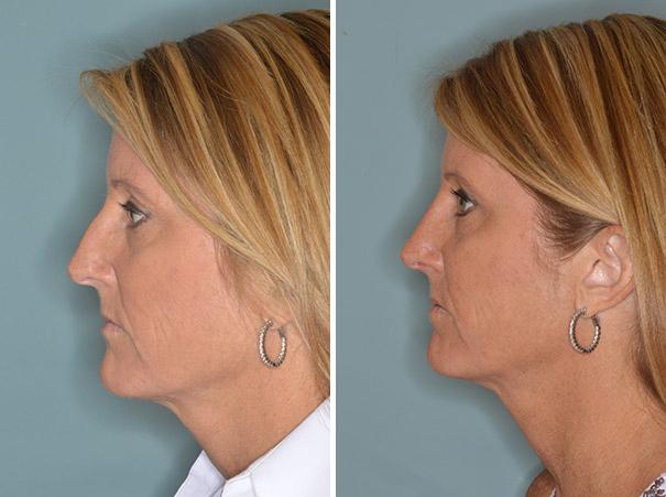 Rhinoplasty Before and After Photos in Miami, FL, Patient 380