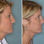Rhinoplasty Before and After Photos in Miami, FL, Patient 380