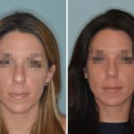Rhinoplasty Before and After Photos in Miami, FL, Patient 391