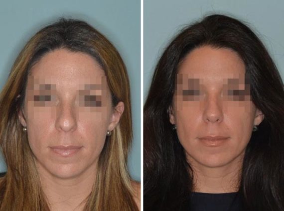 Rhinoplasty Before and After Photos in Miami, FL, Patient 391