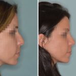 Rhinoplasty Before and After Photos in Miami, FL, Patient 391