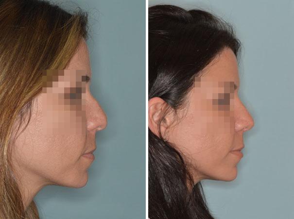 Rhinoplasty Before and After Photos in Miami, FL, Patient 391