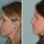 Rhinoplasty Before and After Photos in Miami, FL, Patient 391