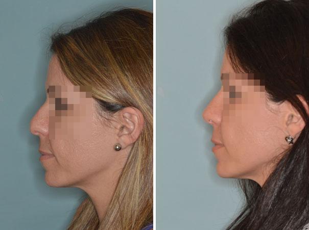 Rhinoplasty Before and After Photos in Miami, FL, Patient 391