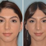 Rhinoplasty Before and After Photos in Miami, FL, Patient 401
